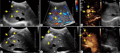 Ultrasound-guided thermal ablation versus laparoscopic surgery for focal nodular hyperplasia of the liver: A retrospective controlled study